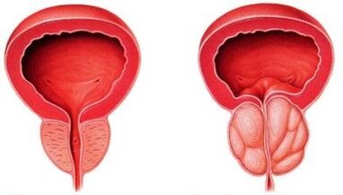 próstata sana e inflamada con prostatitis
