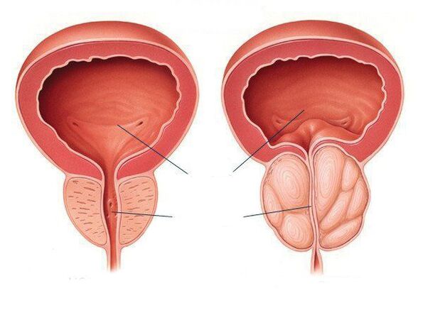 inflamación normal de la próstata y la próstata